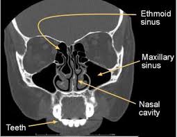 سی تس اسکن ,سی تی اسکن سینوس , سینوزیت , sinus ct scan